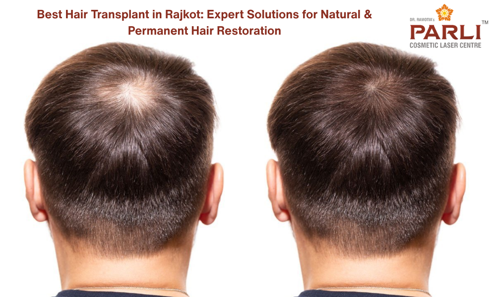 Best Hair Transplant in Rajkot Expert Solutions for Natural and Permanent Hair Restoration